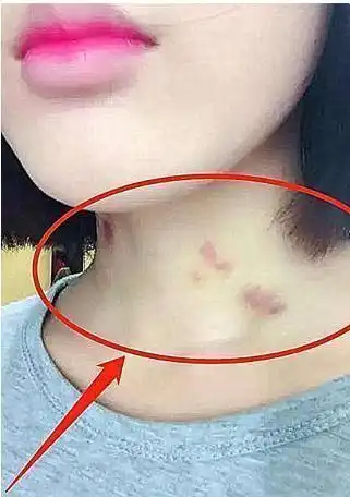 13岁女孩脖子上草莓印瞩目,父母质问缘由,孩子的回答很心酸
